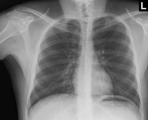 PA Akciğer Grafisi image